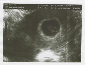 Sonogram Pic 2
